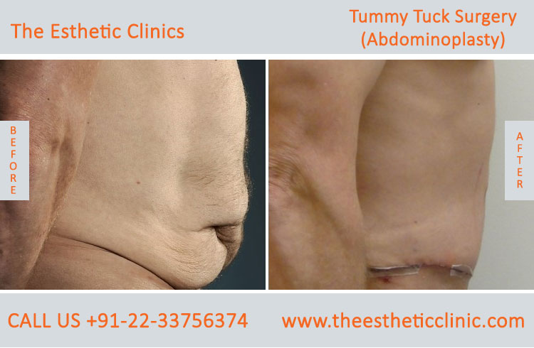 Tummy Tuck Surgery, Abdominoplasty before after photos in mumbai india (3)